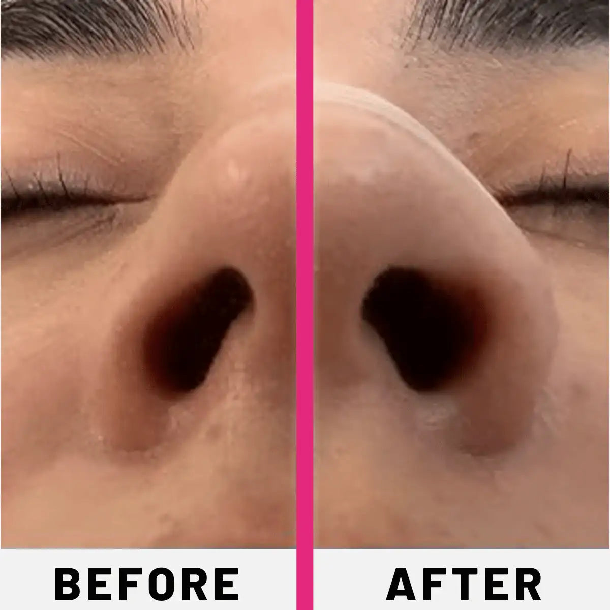 Before and after comparison of a nose with dark spots.